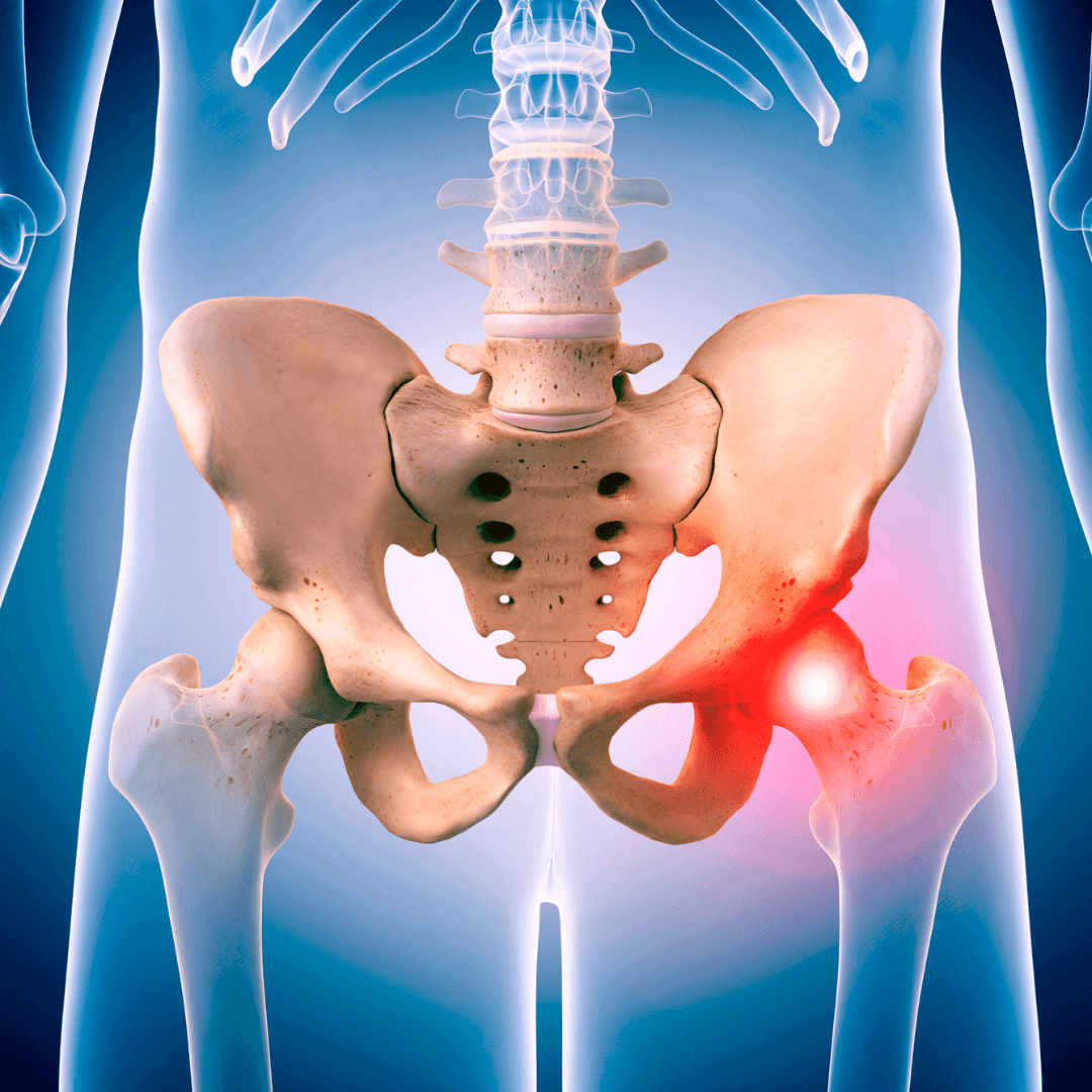 Hip pain condition Prolotherapy