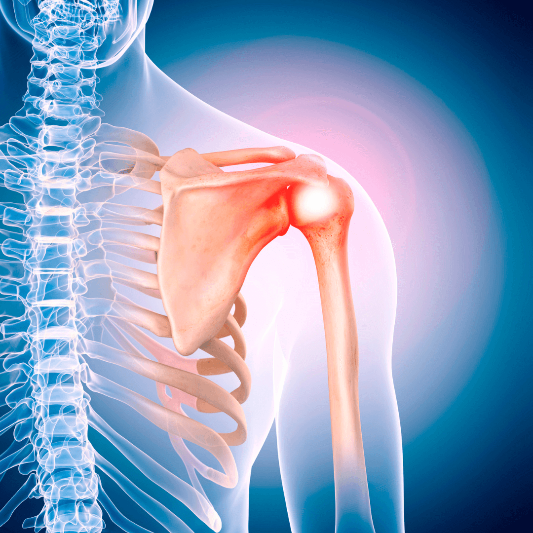 Shoulder Pain condition Prolotherapy